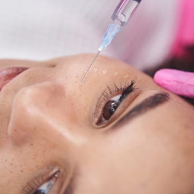 Smiling lady lies with her eyes open while a beauty product is injected into her right cheek